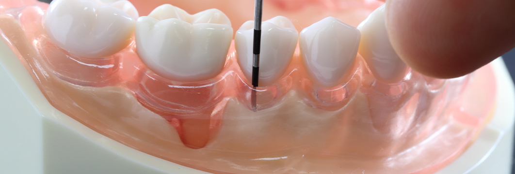 歯周病治療の検査・治療